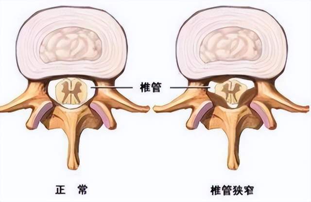 腰椎椎管矢状径图片