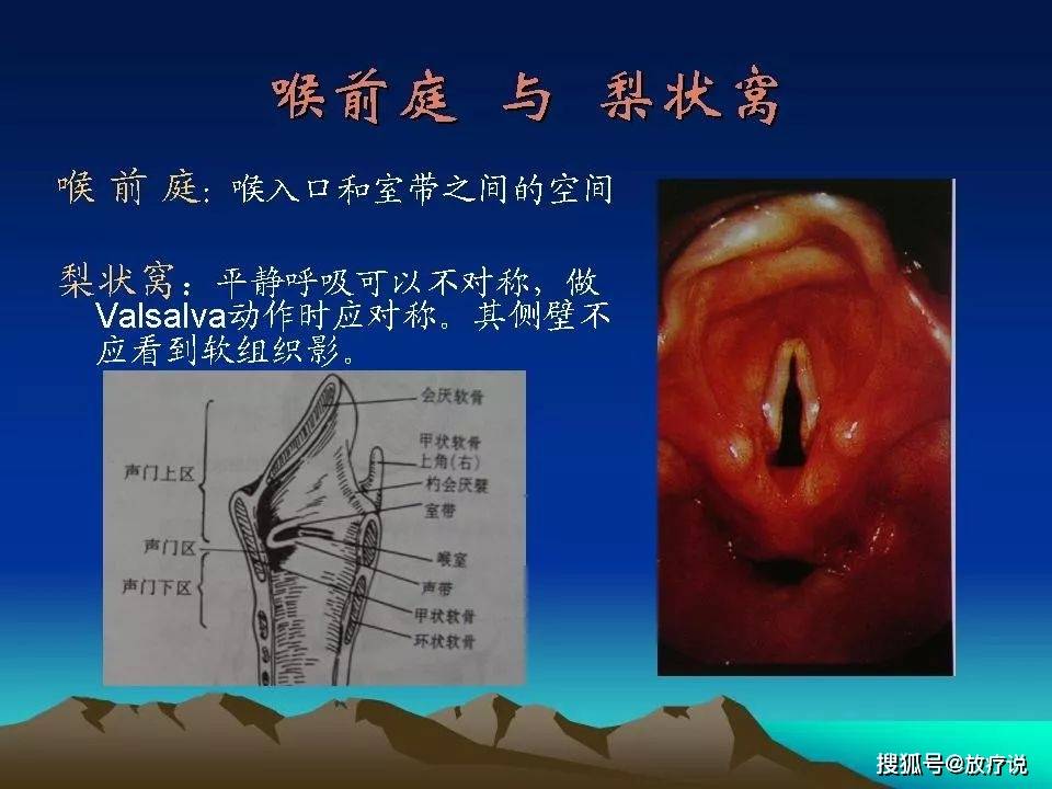 原创喉癌的ctmri诊断今天它来了