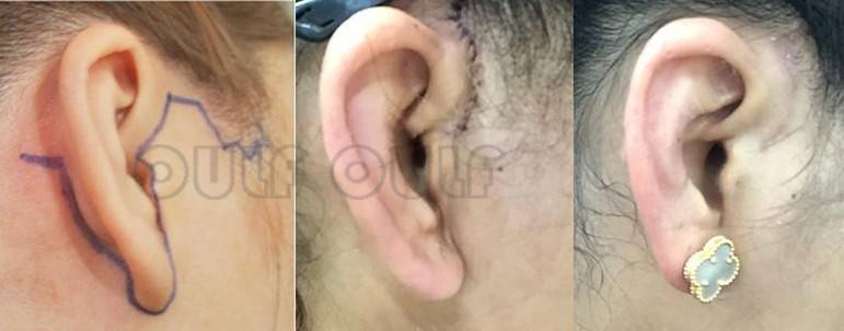 扒皮拉皮手术后会有哪些后遗症拉皮手术十年后的情况闺蜜气哭了太难了