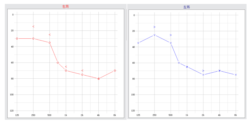 純音測試:雙耳下降型聽力,低頻輕度聽損.