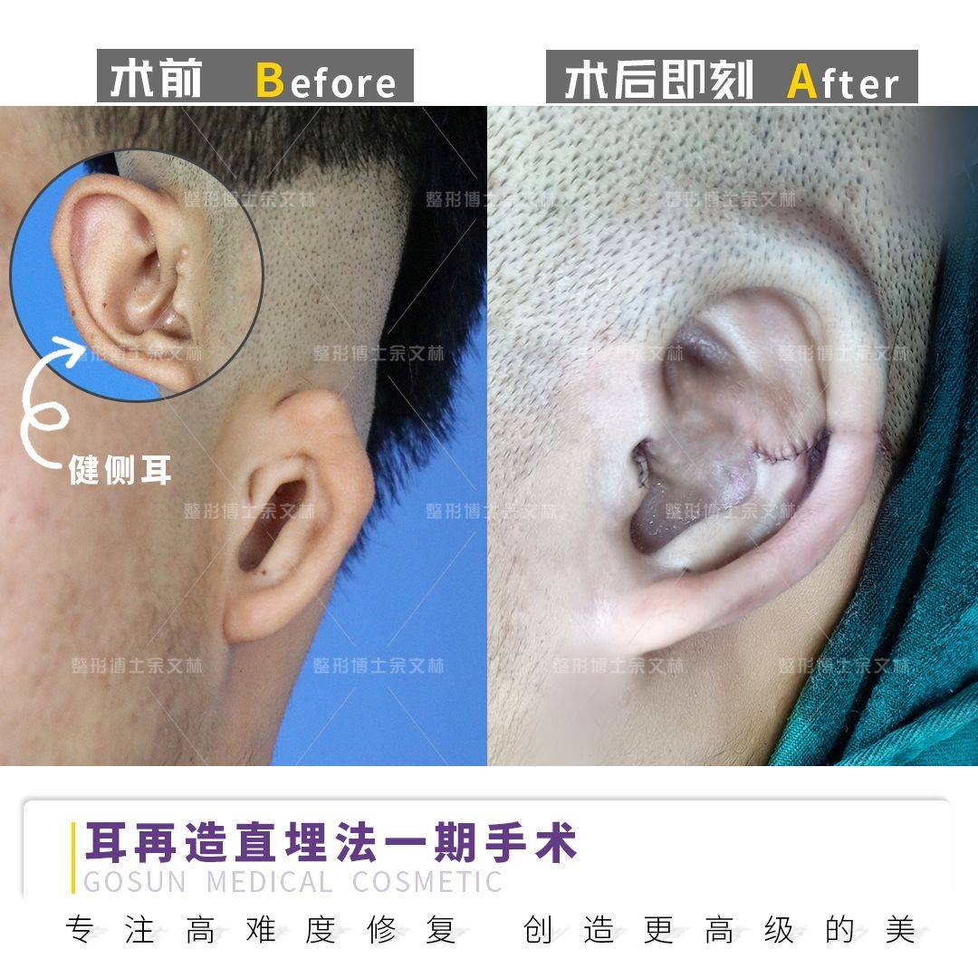 杯状耳怎么矫正盘点杯状耳矫正手术的几种常用方法