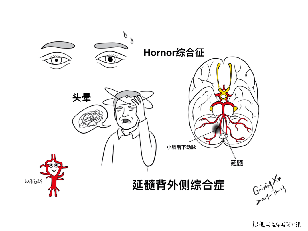 脑干和枕骨大孔的位置关系去皮层强直,去脑强直weber(大脑脚)综合征