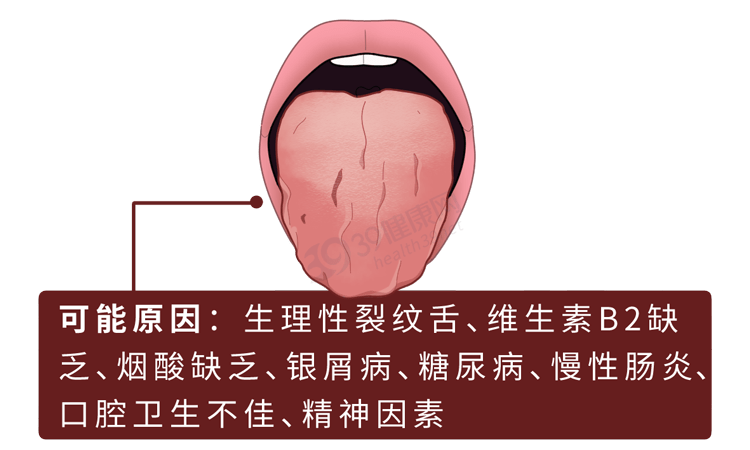 提醒:舌头出现这些变化,可能是生病了_舌苔_口腔_乳头