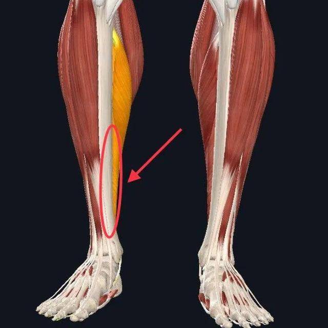 圖為脛骨內側應力綜合徵疼痛區,常出現在跑步愛好者,主要由於肌肉不