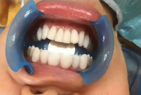 嗑出"瓜子牙"可千万别不当回事,小心小缝不补,变大后追悔莫_牙齿_患者