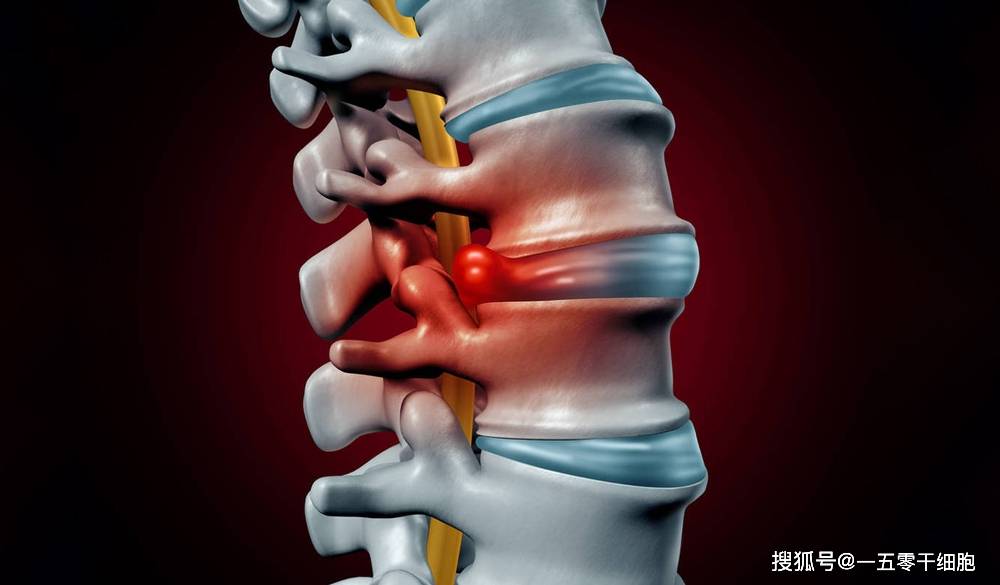 干细胞在椎间盘疾病中的应用案例