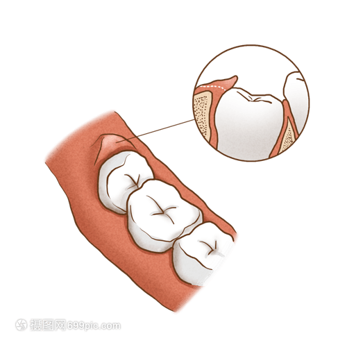阻生的智齿牙冠周围软组织与牙齿之间形成一盲袋,引起食物,细菌的积存