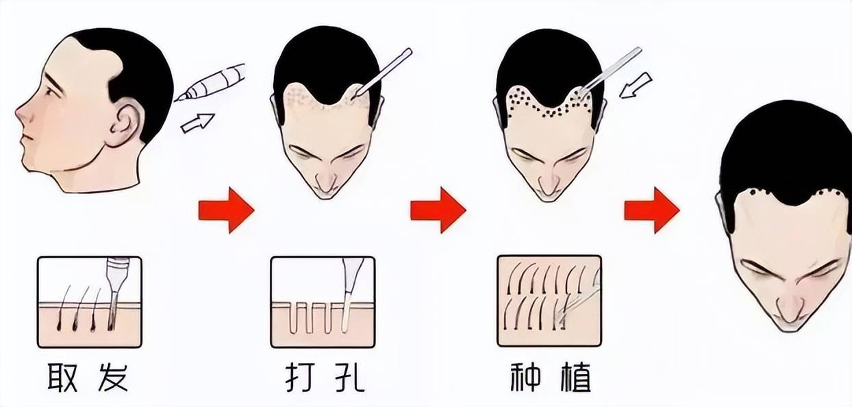 中年秃顶头顶头发可以种植吗移植后需要注意什么事项