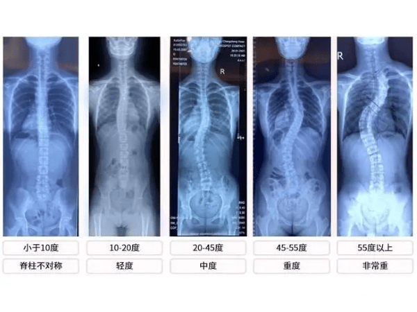 轻度的脊柱侧弯患者通常无症状.