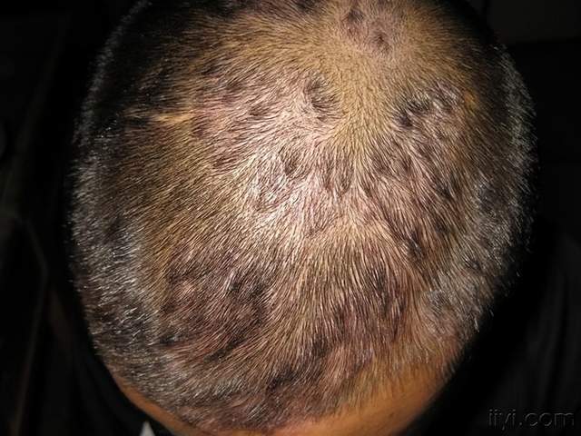 为何头皮上总是长疙瘩和脓包呢？是病吗？听听医生怎么说_牛皮_洗头_时候