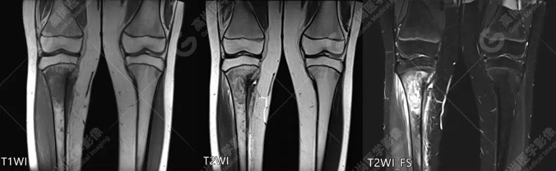 【高尚病例】胫骨骨肉瘤一例_检查_恶性肿瘤_诊断