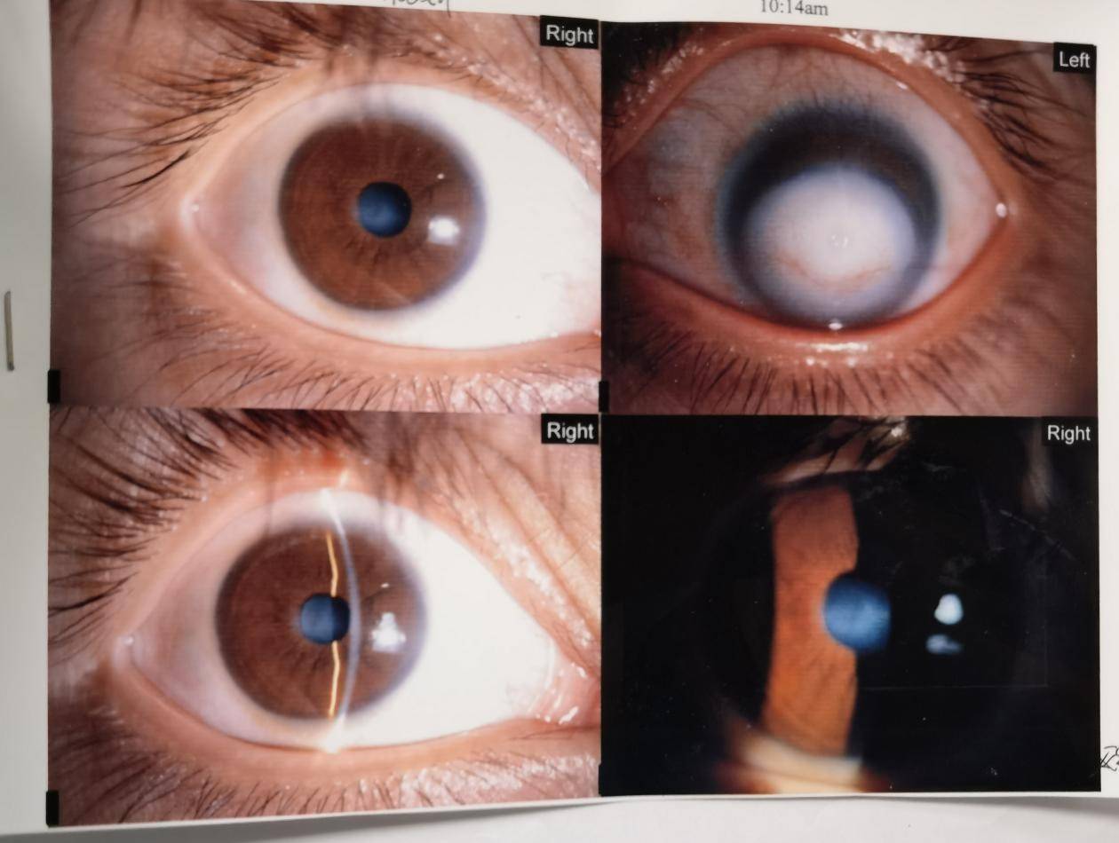 仔细的检查,娇娇被诊断为左眼角膜白斑,双眼泪道狭窄,右眼角膜云翳