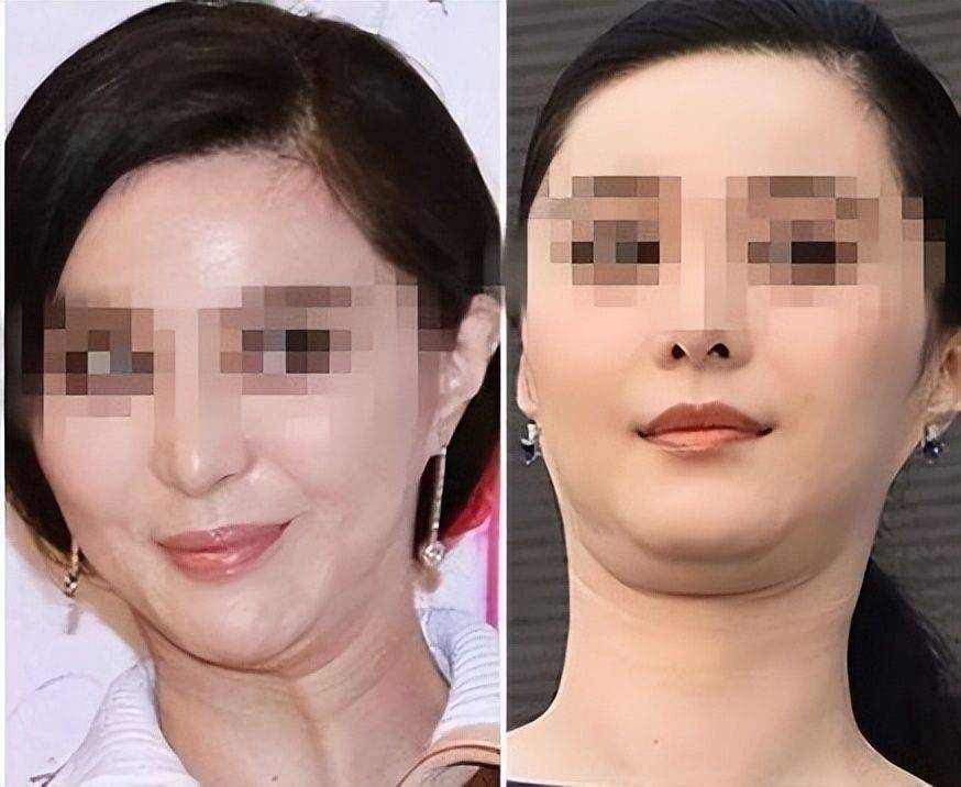 当然,很多双下巴都是复合问题,比如脖子又前倾皮肤又松弛,下颌骨窄