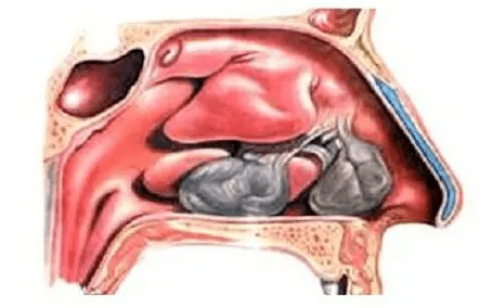鼻部肿瘤如果出现糜烂出血坏死,就会导致鼻腔能够闻到腥臭味,如果发现