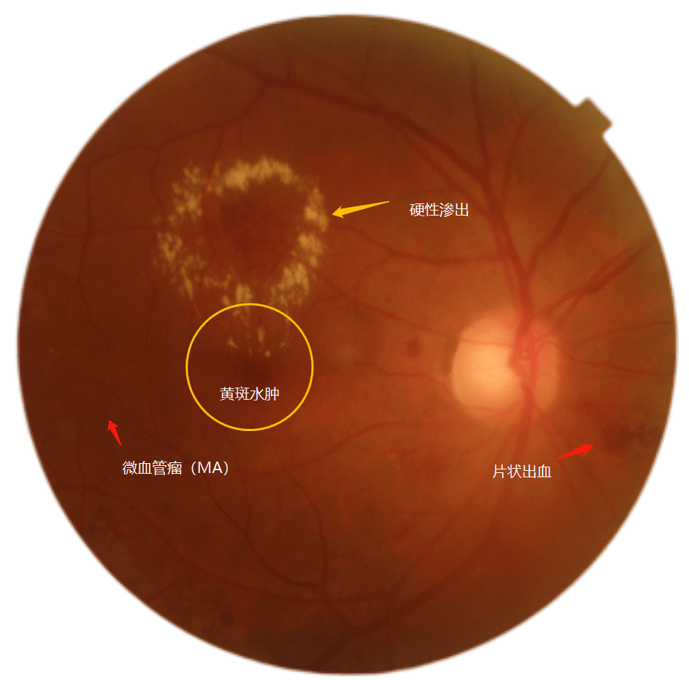 结果查出眼底出血,双眼视网膜血管病变,右眼伴有黄斑病变(黄斑水肿)