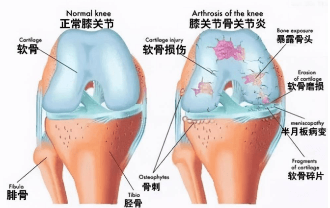 10条膝关节保护行为准则请收下_运动_膝盖_软骨