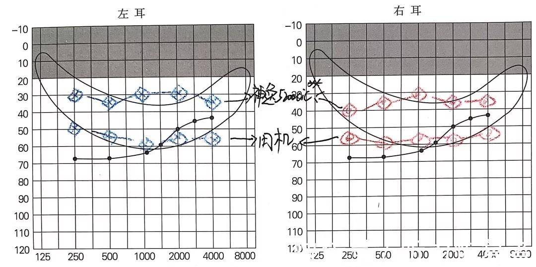 耳硬化症纯音测听图图片