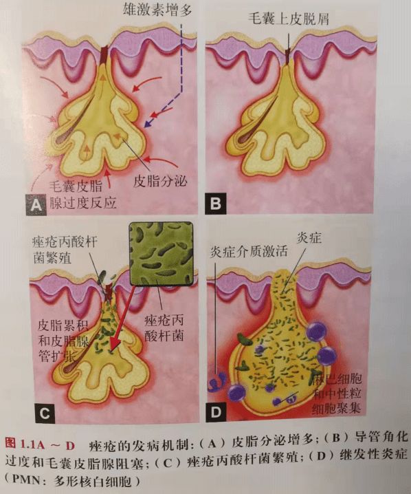 科普痤瘡瘢痕的病理生理與分類