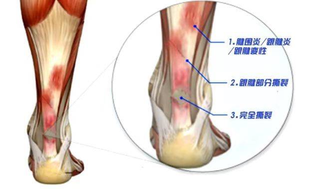 跟腱炎顽固不好消除揭秘跟腱炎治愈手段