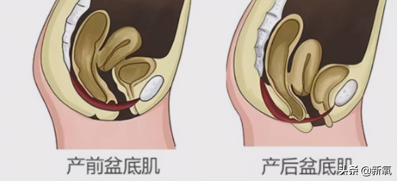 生育給人帶來的身體改變不單單表現在盆底肌上,還表現在生殖器官上.