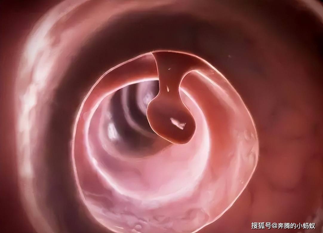 胃息肉有哪些临床表现有哪些?如何治疗?_患者_癌变_症状