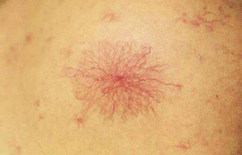 蜘蛛痣是肝脏病变的症状.