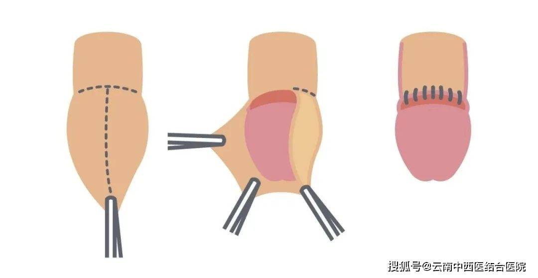 手术治疗:如透明质酸阴茎头增粗术,包皮环切术,阴茎系带羊肠线植入术