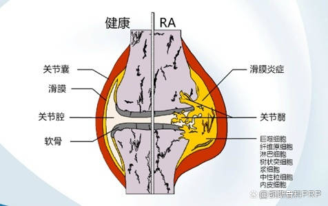 膝关节腔注射图解图片