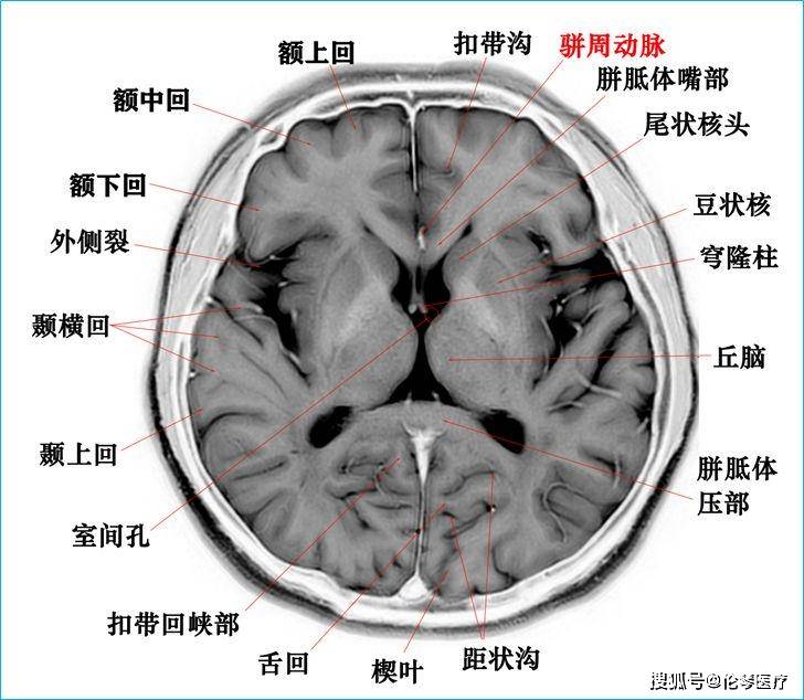 高清顱腦斷層解剖圖譜【磁共振 大體標本】_侵權_文字_後臺