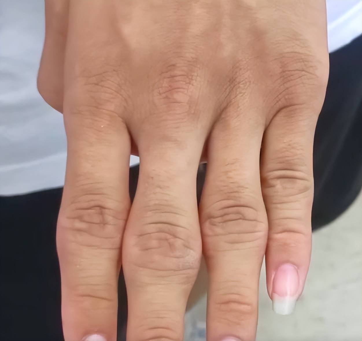 原创15岁男孩双手严重变形医生常做的一个动作可能导致手指异常