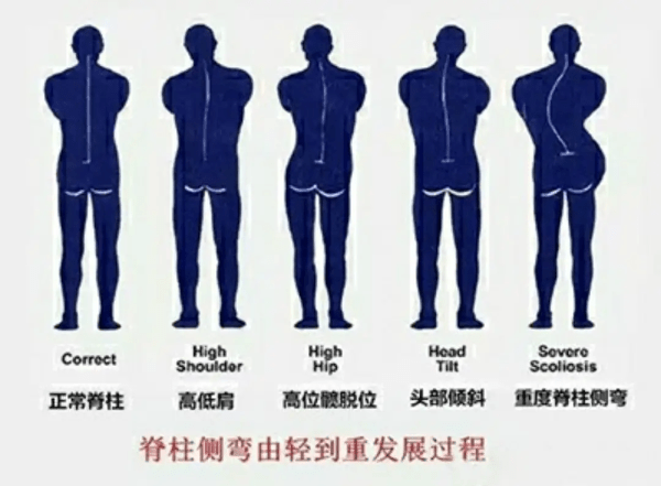 可以将脊柱侧弯分为不同的类型:1,特发性脊柱侧弯常见的脊柱侧弯类型