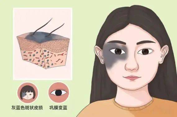 太田痣治疗期间需要注意什么