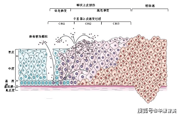 cin2和cin3锥切术后还要复查吗?_治疗_高级别_病变
