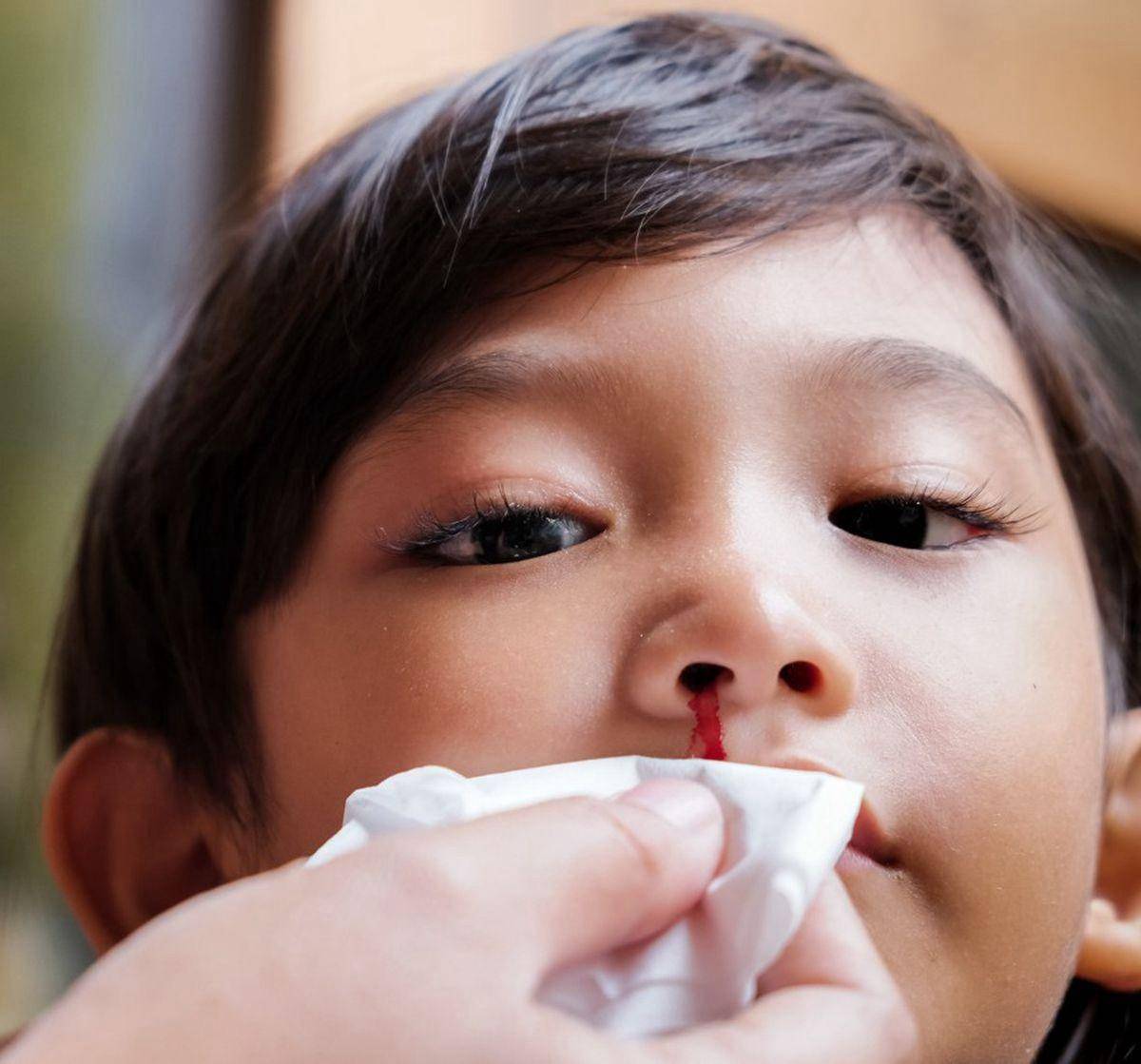 孩子流鼻血处理不当有窒息的风险正确方法在这里家长快收藏