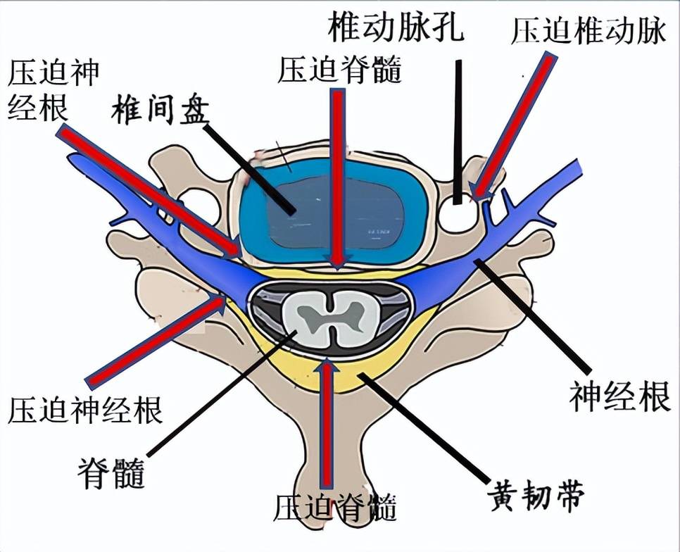 颈3椎体解剖图片