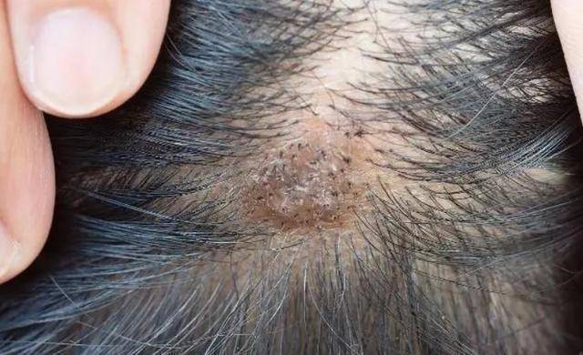 医生暗示:3种病或要考虑其中_头部_女性_头发