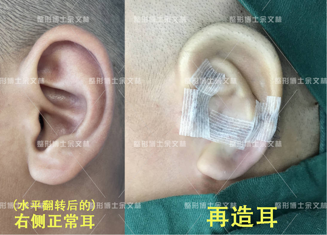 手术效果:术后再造耳廓与对侧耳廓大小一致,对耳轮等结构明显,轮廓