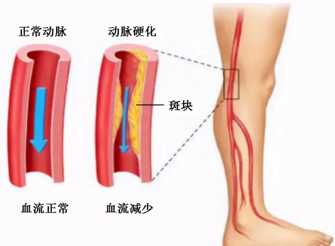 正常腿部血管图片图片
