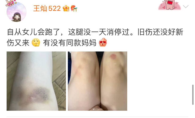 女生腿受伤的照片图片