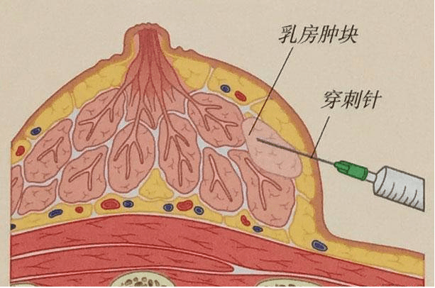 乳腺纤维瘤的位置图片图片