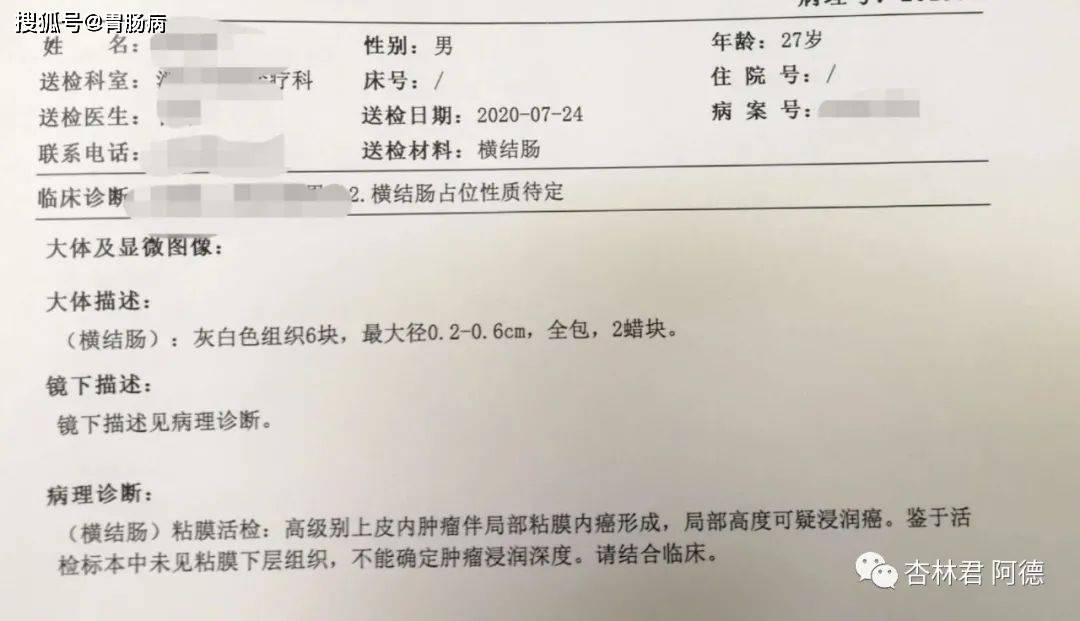 原创
27岁就得了肠癌!冤不冤?
关于大肠癌的遗传性和家族聚集性肠癌预防太简单,如果患上实在冤!通过这2个例子,我想告诉大家以下几点:哪些病人必须做结肠镜检查?