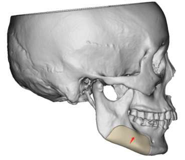 新技术 | 哈医大一院口腔颌面外科完成我省首例人工新材料数字化修复