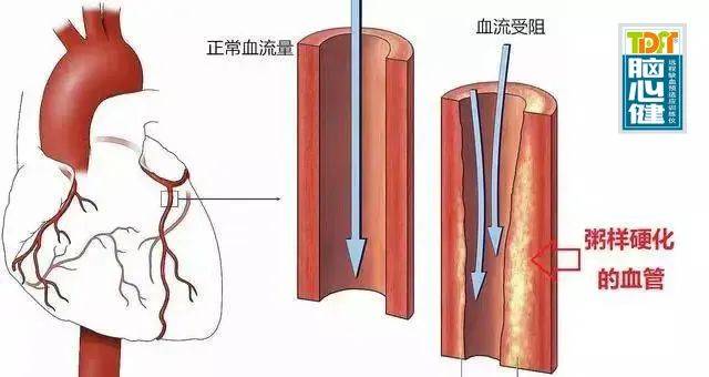 动脉粥样硬化的原因及预防_血管_疾病_人体