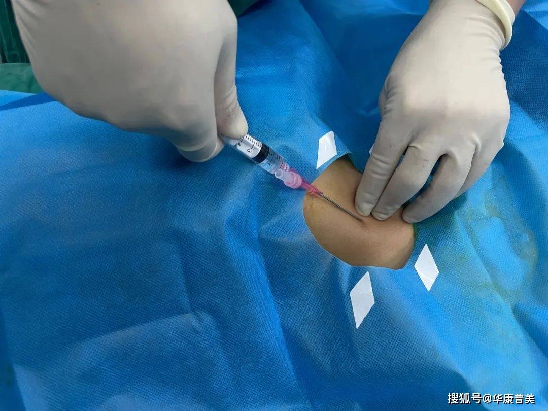 关于中心静脉置管技术你需要知道的那些事儿_锁骨_cm_患者