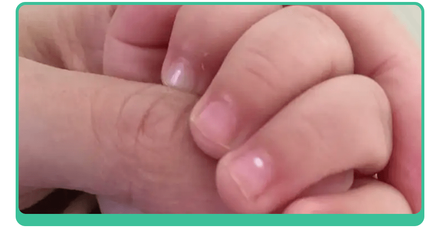 白斑、薄脆、凹陷,娃指甲有异常,不是缺营养,可能暗藏疾病