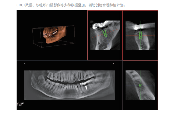 為什麼種植牙要拍口腔cbct以及它有哪些臨床優勢