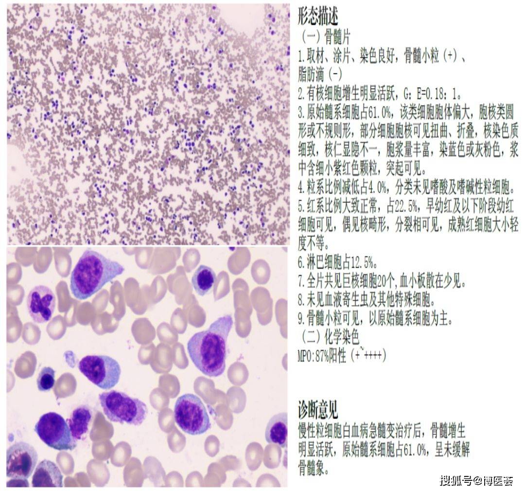 骨髓细胞学检查报告单图片