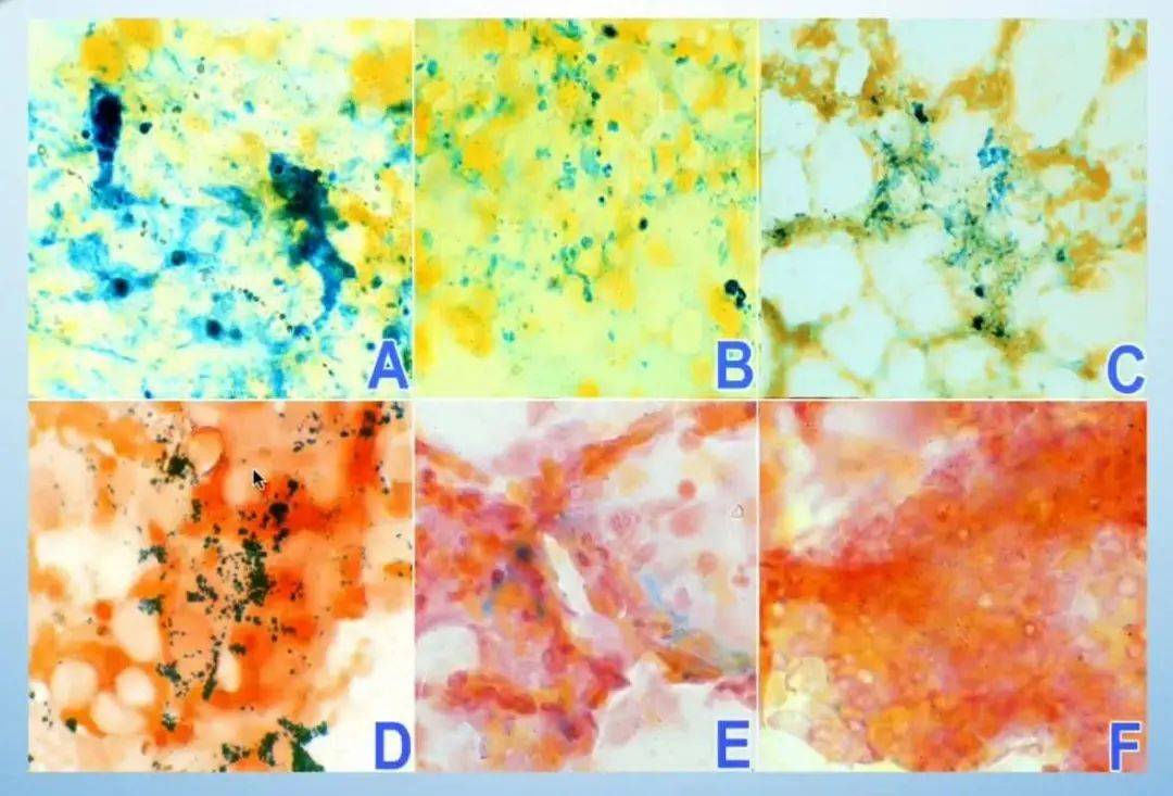 浅析骨髓细胞学检查_染色_诊断_疾病