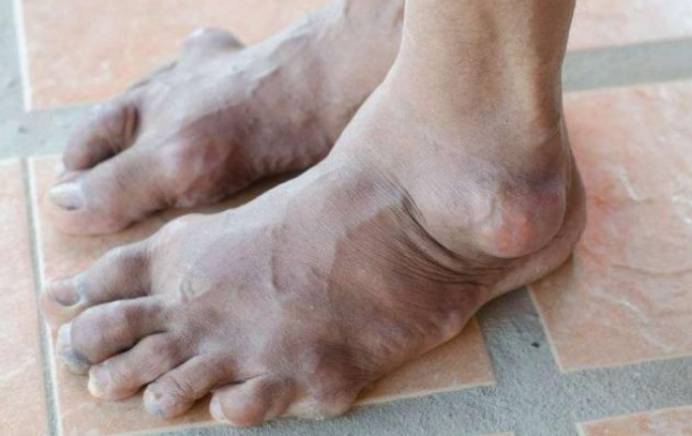 尿酸升高,脚部预言!1.