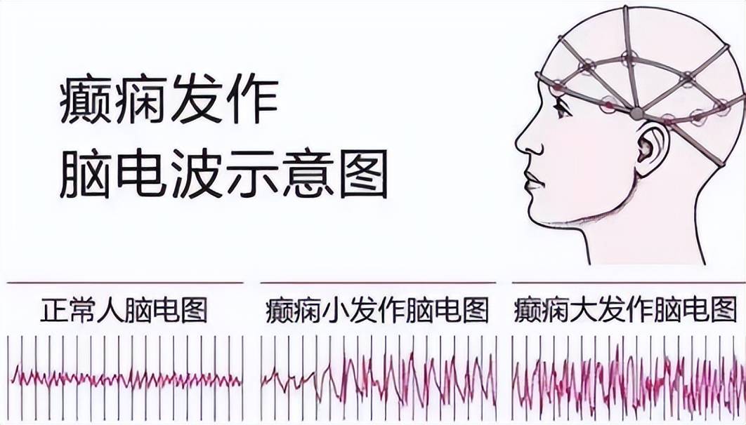 脑电图报告单图片